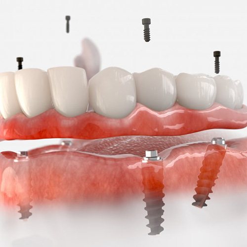 a 3D illustration of an implant denture