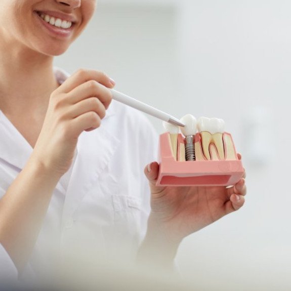 A dentist holding a model of a dental implant