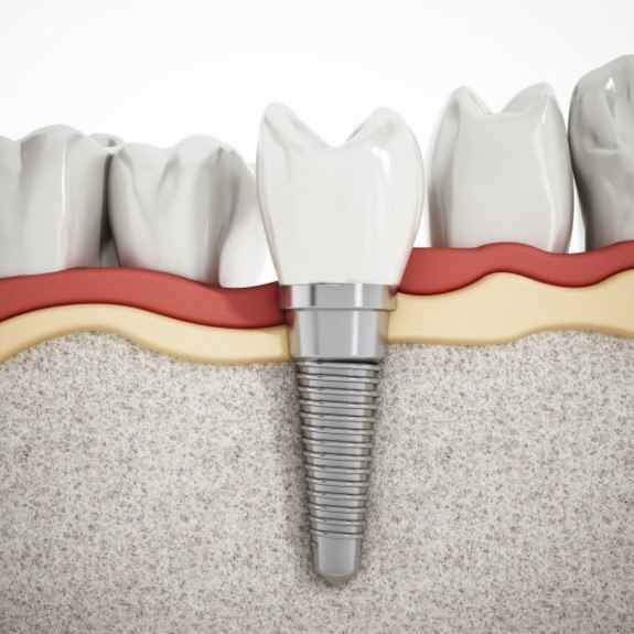 A 3D illustration of a dental implant in the jawbone