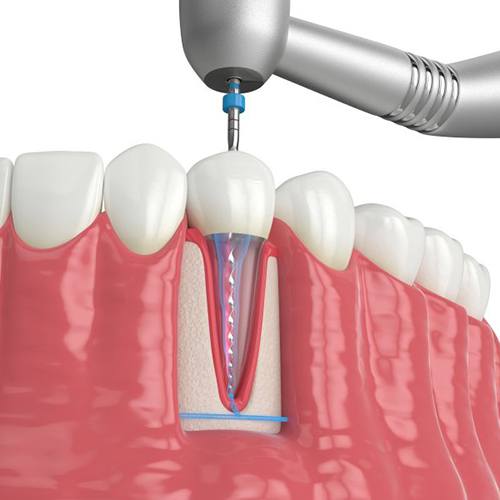 a 3D depiction of a root canal process